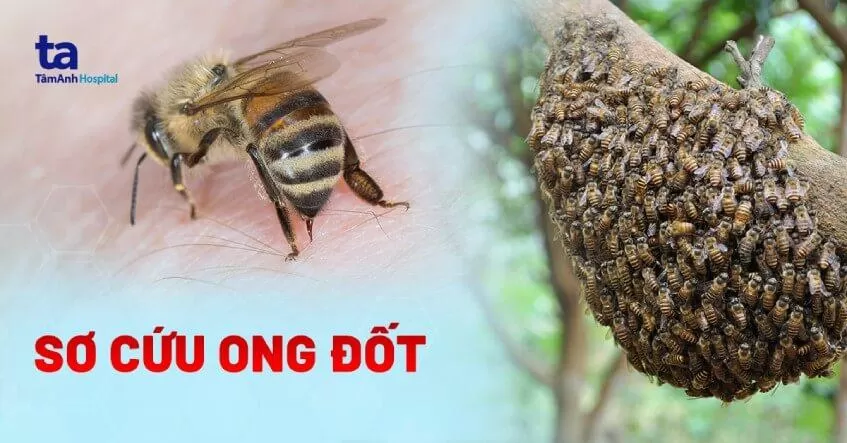 ong bắp cày đốt có nguy hiểm không